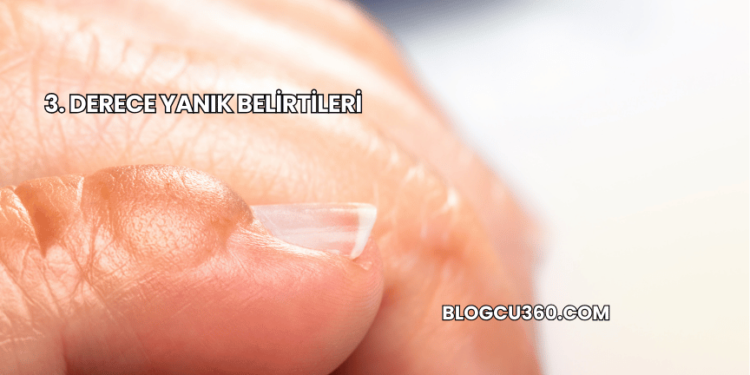 3. Derece Yanık Belirtileri