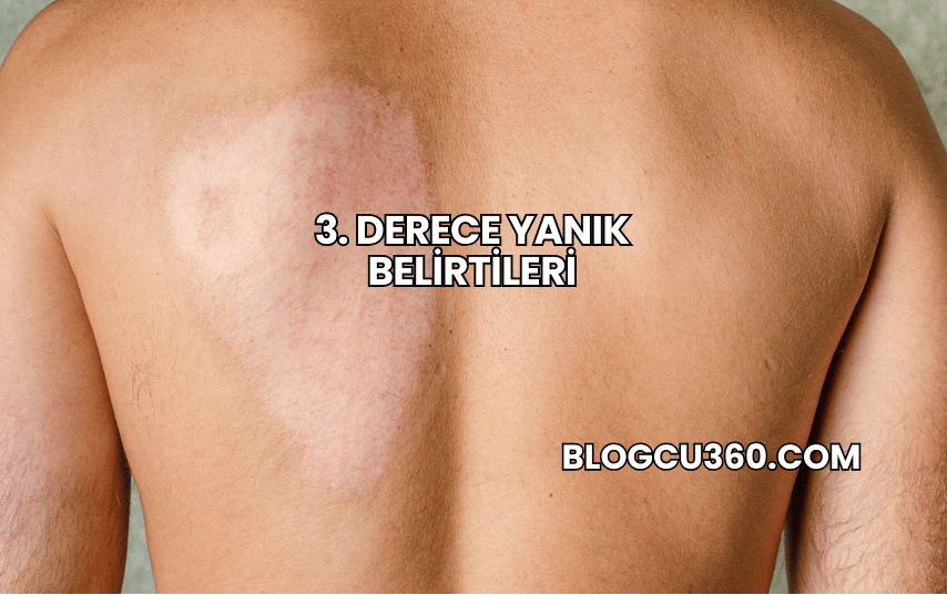 3. Derece Yanık Belirtileri