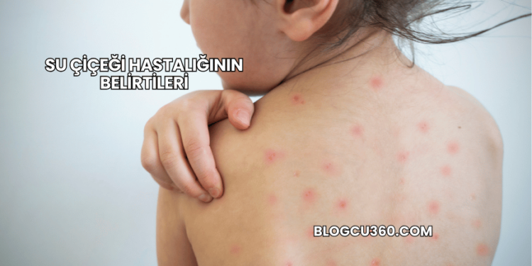 Su Çiçeği Hastalığının Belirtileri