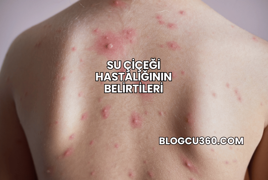 Su Çiçeği Hastalığının Belirtileri