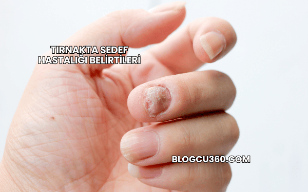 Tırnakta Sedef Hastalığı Belirtileri