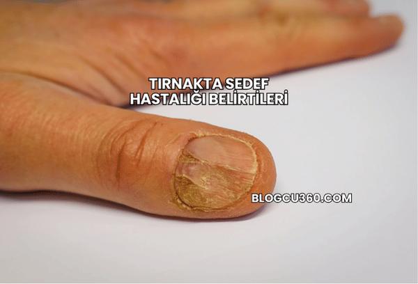 Tırnakta Sedef Hastalığı Belirtileri