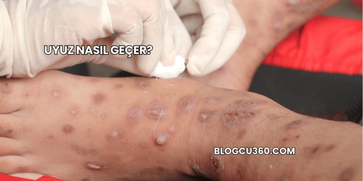 Uyuz Nasıl Geçer?
