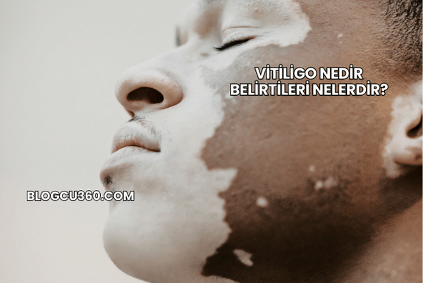 Vitiligo Nedir Belirtileri Nelerdir?