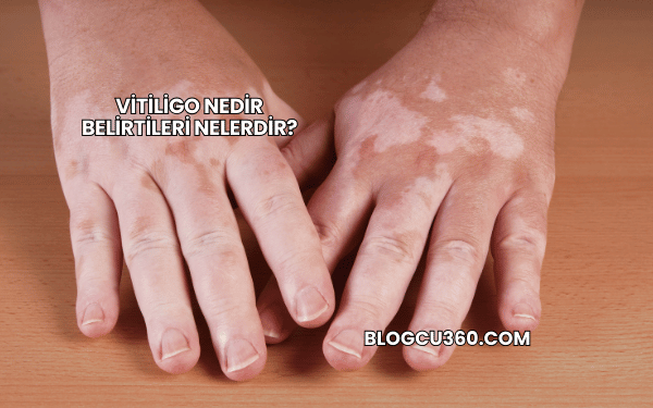 Vitiligo Nedir Belirtileri Nelerdir?