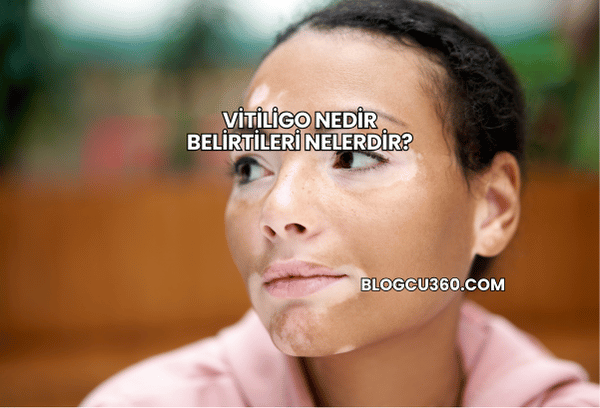 Vitiligo Nedir Belirtileri Nelerdir?