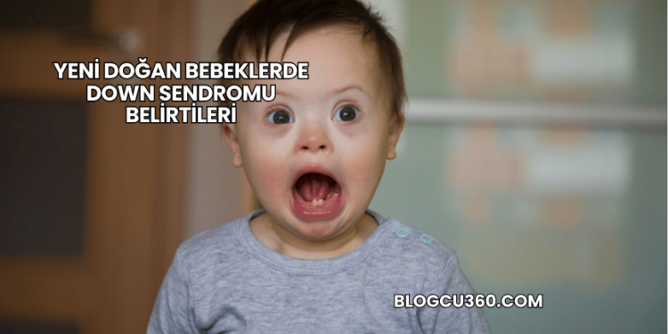 Yeni Doğan Bebeklerde Down Sendromu Belirtileri